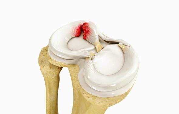 علت بروز مینیسک زانو چیست؟
