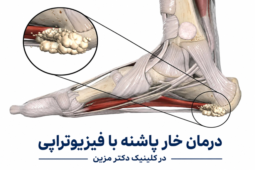 درمان خار پاشنه با فیزیوتراپی