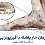درمان خار پاشنه با فیزیوتراپی | مقایسه روش‌ها و راهکارهای کلینیک سعید مزین
